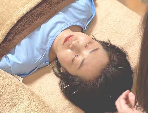 スタンダードコース「お顔の美容鍼」施術写真