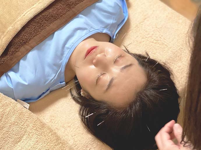 お顔の美容鍼施術写真